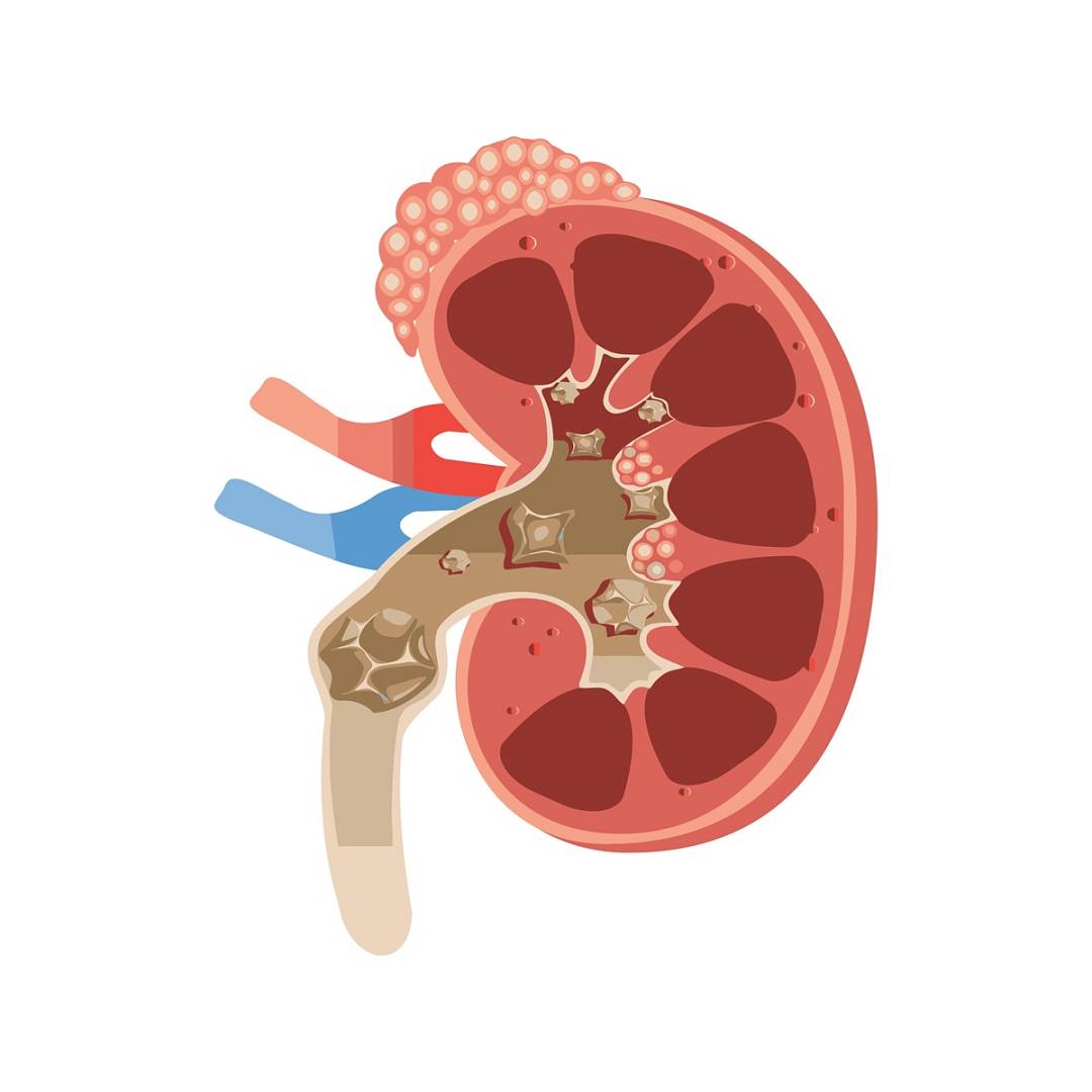 Schemat anatomiczny kamica układu moczowego – kamienie nerkowe w moczowodzie zaburzające przepływ moczu i odpływ moczu do pęcherza moczowego